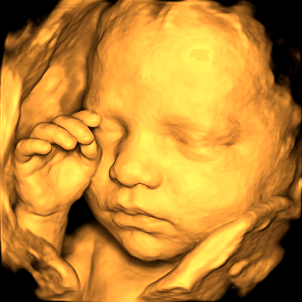 Sample 3D ultrasound scan 1
