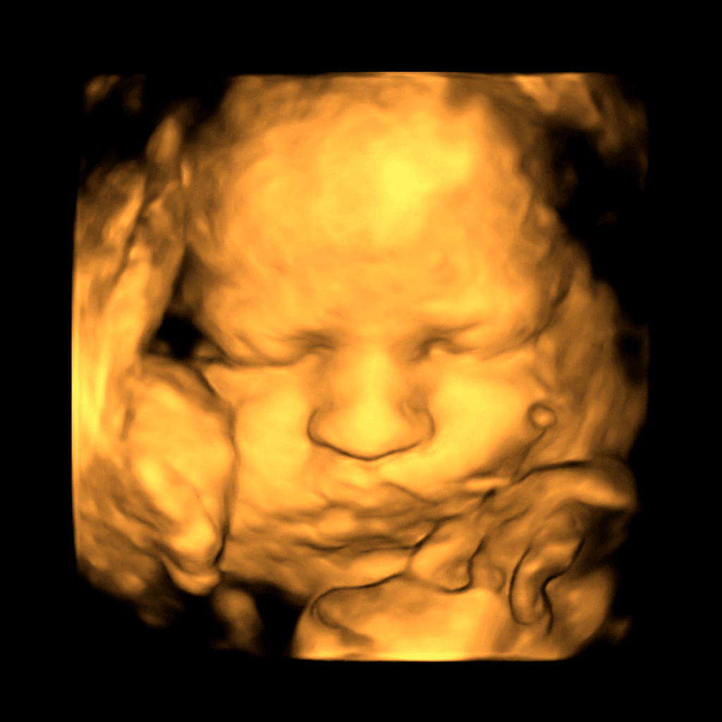 Sample 3D ultrasound scan 2