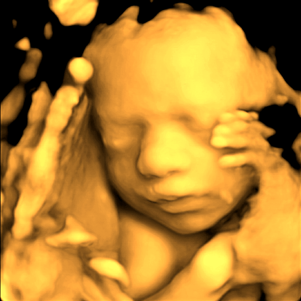 Sample 3D ultrasound scan 3